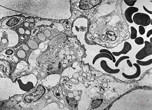 F,49y. | hemangioblastoma - brain